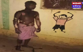 बालोद: शादी से एक हफ्ते पहले युवक ने खुद को आग लगाकर की आत्महत्या की कोशिश, हालत गंभीर