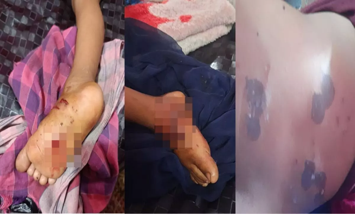 भिलाई में आवारा कुत्तों का आतंक: मासूम को नोंचकर किया लहूलुहान, 4 साल से नसबंदी ठप, प्रशासन की बड़ी लापरवाही उजागर