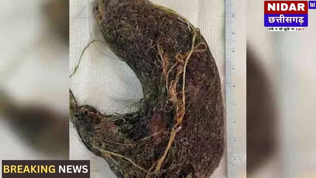चमत्कार! 7 साल के बच्चे के पेट से निकला बालों का गुच्छा और धागा