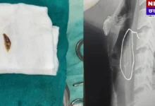 Shajapur News: चिकन का लेग पीस बना जान का दुश्मन! गले में फंसी हड्डी, सांस लेना हुआ मुश्किल, फिर डॉक्टरों ने ऐसे किया 'चमत्कार'