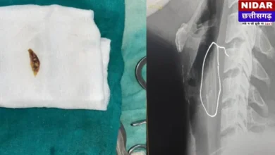 Shajapur News: चिकन का लेग पीस बना जान का दुश्मन! गले में फंसी हड्डी, सांस लेना हुआ मुश्किल, फिर डॉक्टरों ने ऐसे किया 'चमत्कार'