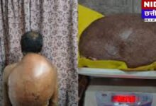 15 साल का दर्द खत्म: रायपुर के डॉक्टरों ने पीठ से निकाला 10.5 किलो का ट्यूमर, मरीज को मिला नया जीवन