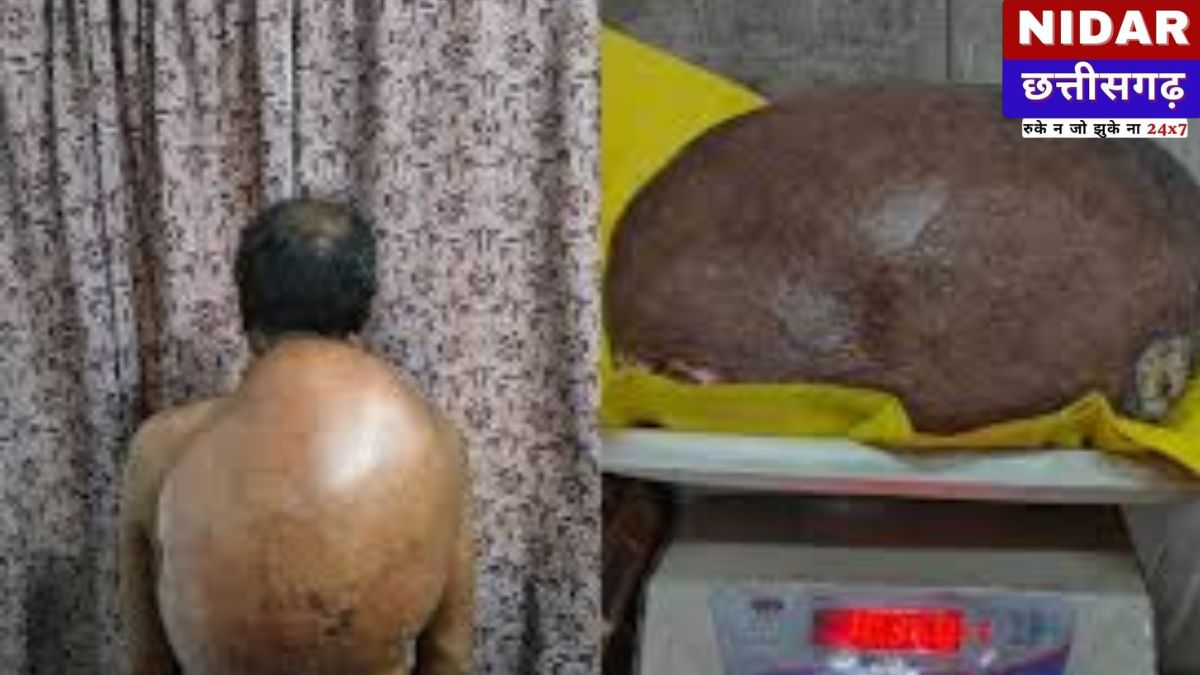 15 साल का दर्द खत्म: रायपुर के डॉक्टरों ने पीठ से निकाला 10.5 किलो का ट्यूमर, मरीज को मिला नया जीवन